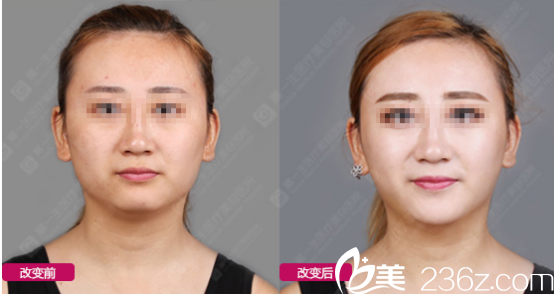 西安高一生注射豐下巴<span style=