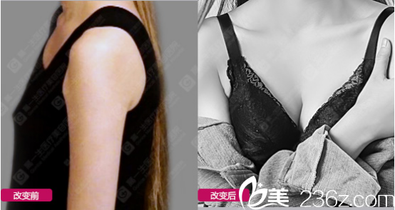 西安高一生假體隆胸<span style=