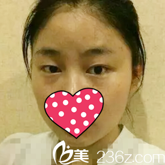 做雙眼皮手術(shù)前 做雙眼皮手術(shù)前