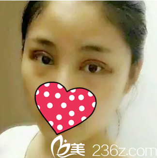 割雙眼皮術(shù)后第二天 割雙眼皮術(shù)后第二天