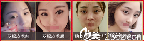 四川美萊眼鼻整形案例