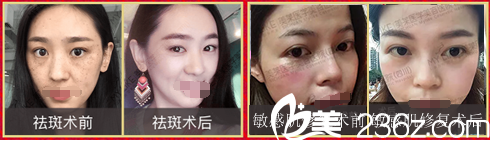 四川成都美萊美膚案例對(duì)比