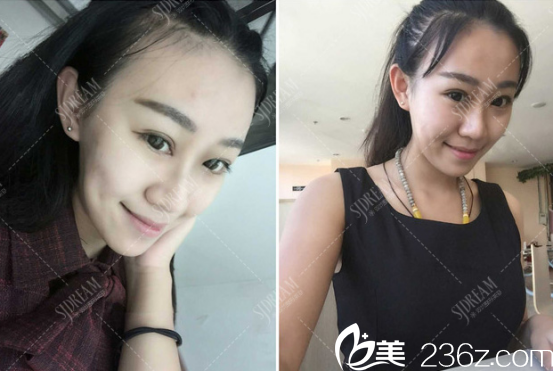 雙眼皮術(shù)后照