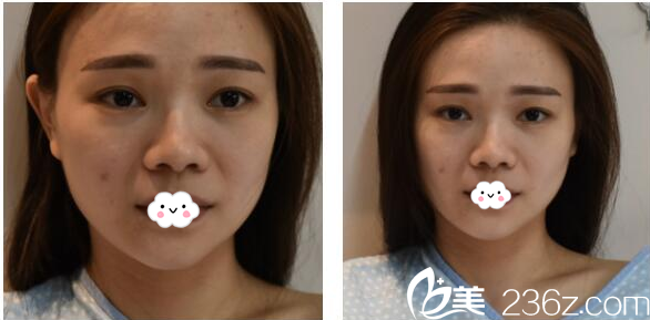 術(shù)前假體隆鼻失敗照片 術(shù)前假體隆鼻失敗照片