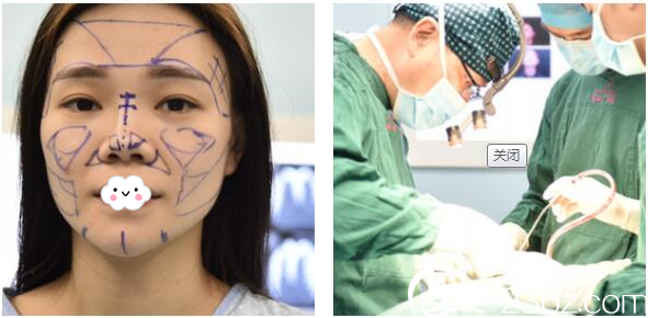 梁曉健院長(zhǎng)隆鼻手術(shù)過(guò)程圖 梁曉健院長(zhǎng)隆鼻手術(shù)過(guò)程圖