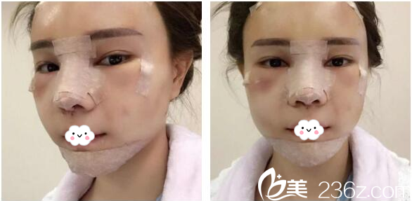 在深圳美萊做隆鼻失敗修復(fù)和脂肪填充2天了 在深圳美萊做隆鼻失敗修復(fù)和脂肪填充2天了