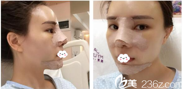 找梁曉健做鼻綜合7天自拍 找梁曉健做鼻綜合7天自拍