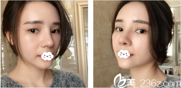 深圳美萊梁曉健隆鼻45天恢復(fù)情況 深圳美萊梁曉健隆鼻45天恢復(fù)情況