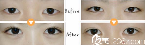 醫(yī)院雙眼皮案例 醫(yī)院雙眼皮案例