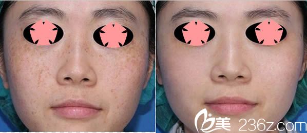 皮秒激光祛斑真實效果對比圖 皮秒激光祛斑真實效果對比圖