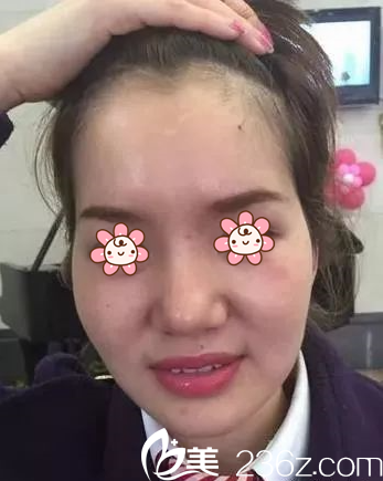 趙弈杉自體脂肪面部填充案例術(shù)前 趙弈杉自體脂肪面部填充案例術(shù)前