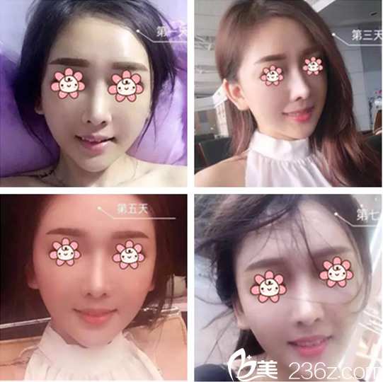 李奕曉紋眉案例