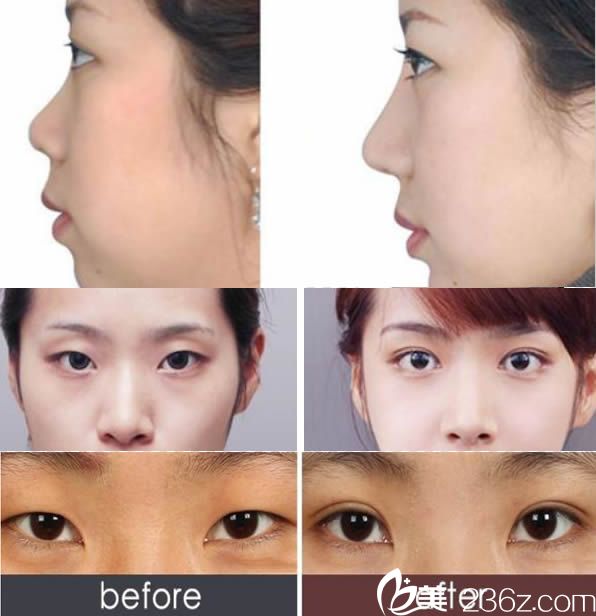 <!--<i data=20240703-sp></i>-->孟鵬勃院長雙眼皮和隆鼻案例 <!--<i data=20240703-sp></i>-->孟鵬勃院長雙眼皮和隆鼻案例