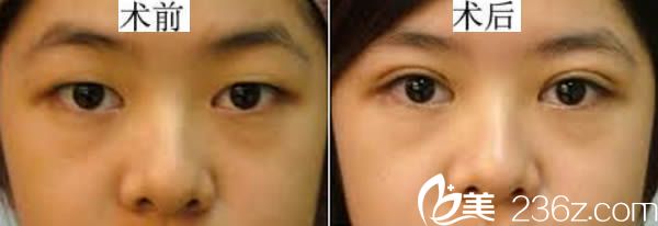 整形孟鵬勃做過的雙眼皮案例圖 整形孟鵬勃做過的雙眼皮案例圖