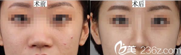 孟鵬勃醫(yī)生鼻綜合隆鼻真實(shí)案例 孟鵬勃醫(yī)生鼻綜合隆鼻真實(shí)案例