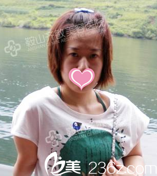 做玻尿酸填充面部前 做玻尿酸填充面部前