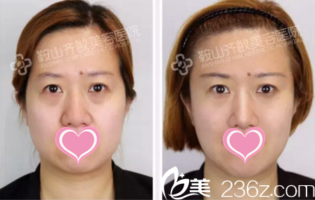 全面部玻尿酸填充前后對(duì)比 全面部玻尿酸填充前后對(duì)比