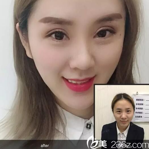 雙眼皮案例 雙眼皮案例