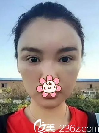 何山醫(yī)生給我做完后第四天的樣子