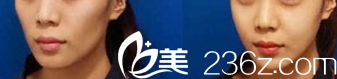 北京博美醫(yī)療美容診所徐向民自體脂肪填充蘋果肌案例 北京博美醫(yī)療美容診所徐向民自體脂肪填充蘋果肌案例