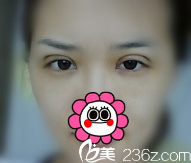 雙眼皮第五天時(shí)不那么腫了