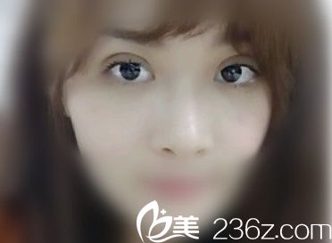 15天時(shí)雙眼皮還有點(diǎn)寬