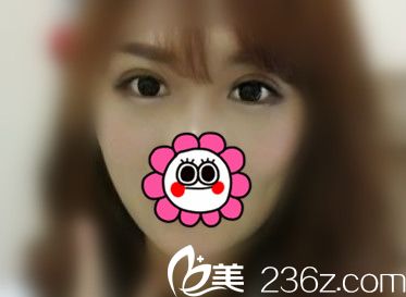 李建剛雙眼皮整形第22天