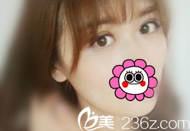 以前顏值低 是因為我沒讓蘭州皙妍麗整形李建剛主任做切開法雙眼皮