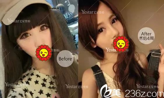 嘉興藝星張占召假體隆鼻案例 嘉興藝星張占召假體隆鼻案例