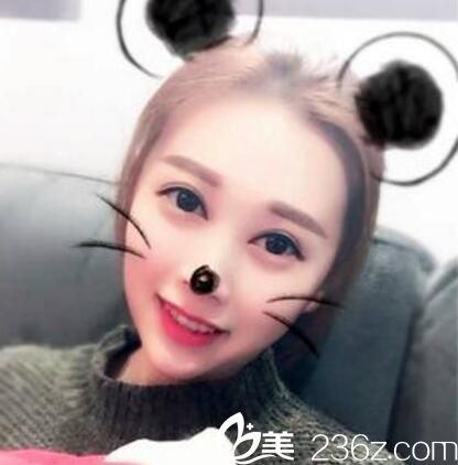 整形蔣新力給我做的3D媚眼術(shù)我感覺挺值的