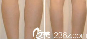 北京印正山鄭泰成腿部吸脂案例 北京印正山鄭泰成腿部吸脂案例