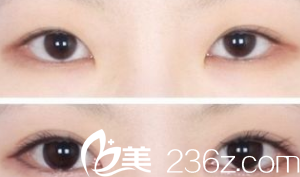 北京印正山醫(yī)療美容診所<!--<i data=20240703-sp></i>-->雙眼皮案例 北京印正山醫(yī)療美容診所<!--<i data=20240703-sp></i>-->雙眼皮案例