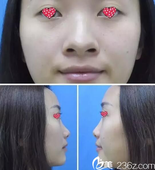 隆鼻術(shù)前樣子 隆鼻術(shù)前樣子