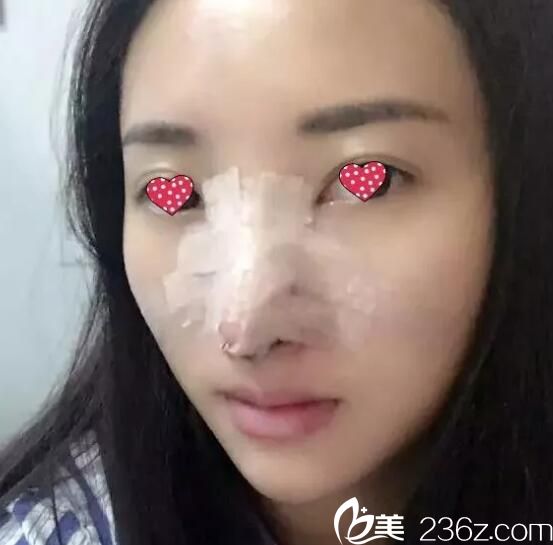 剛做完鼻綜合術(shù)后 剛做完鼻綜合術(shù)后