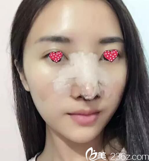 術(shù)后第三天隆鼻恢復(fù) 術(shù)后第三天隆鼻恢復(fù)