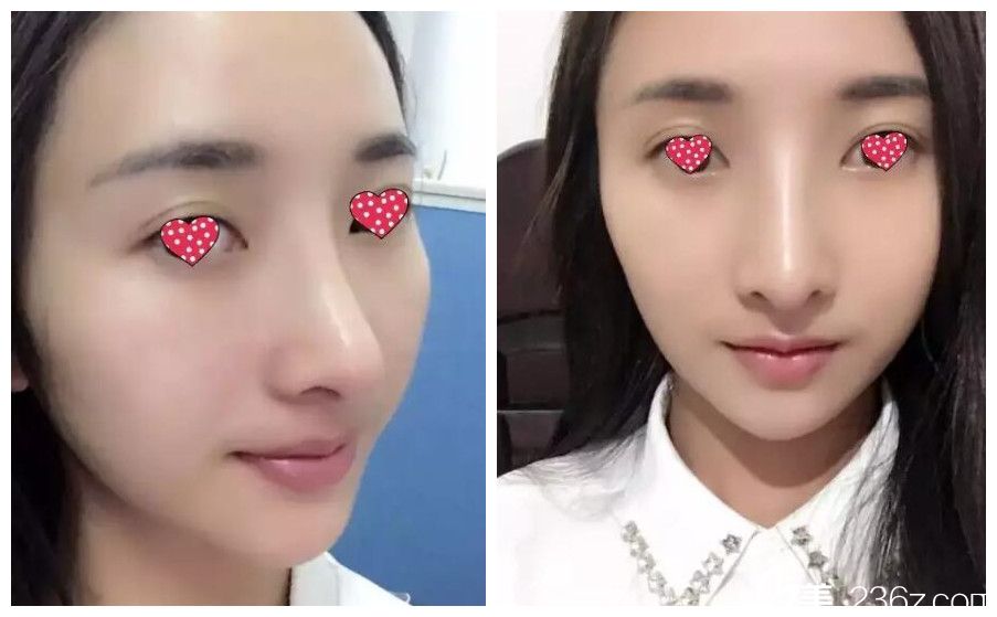 術(shù)后五天拆線鼻綜合恢復(fù) 術(shù)后五天拆線鼻綜合恢復(fù)