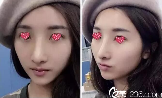 大而圓的鼻頭外加低鼻梁在宿遷天黛做達(dá)拉斯綜合隆鼻蛻變歷程