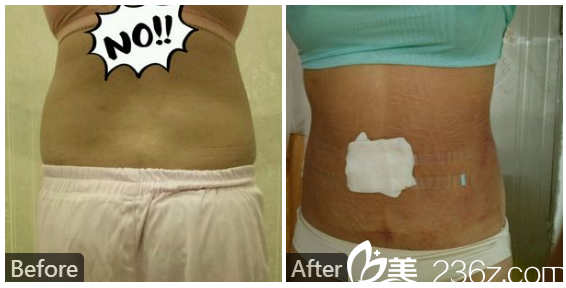 寶雞高一生整形醫(yī)院楊善主任吸脂案例