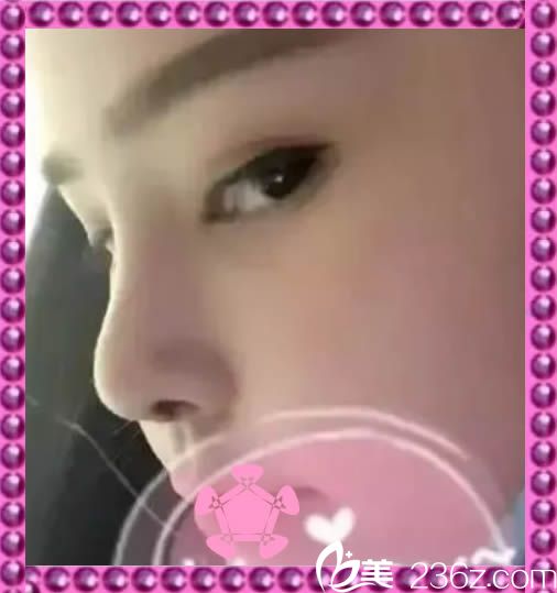 我一個月前讓孟鵬勃院長做了鼻綜合，讓我遠離了隆鼻失敗案例