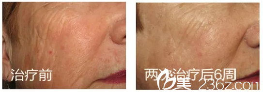 揭陽(yáng)華美整形醫(yī)院超皮秒除皺緊膚案例