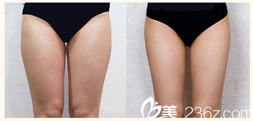 揭陽(yáng)華美整形醫(yī)院大腿吸脂案例
