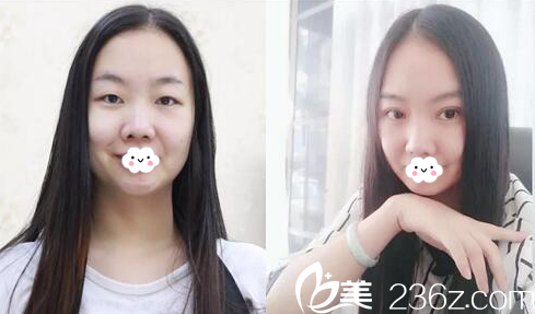 揭陽(yáng)華美整形醫(yī)院張旭做的雙眼皮案例