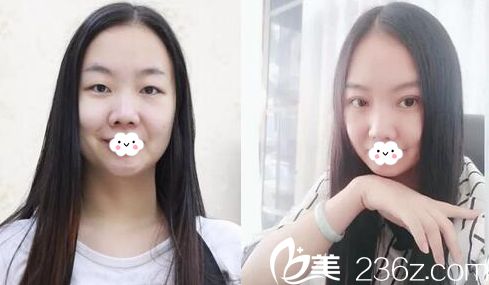 揭陽華美整形醫(yī)院張旭醫(yī)生做的雙眼皮案例 揭陽華美整形醫(yī)院張旭醫(yī)生做的雙眼皮案例