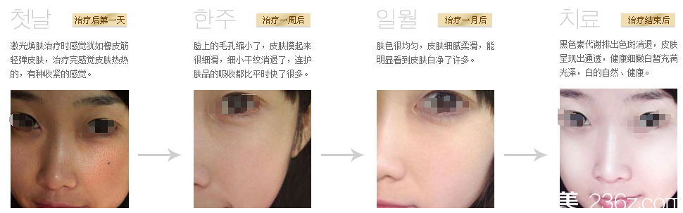 連云港美締激光煥膚案例