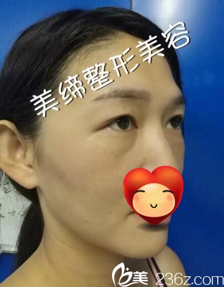 面部脂肪填充術(shù)前照片 面部脂肪填充術(shù)前照片