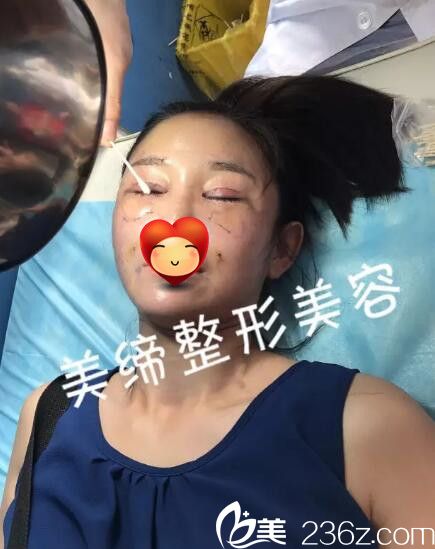 眼綜合整形手術(shù)過程中 眼綜合整形手術(shù)過程中