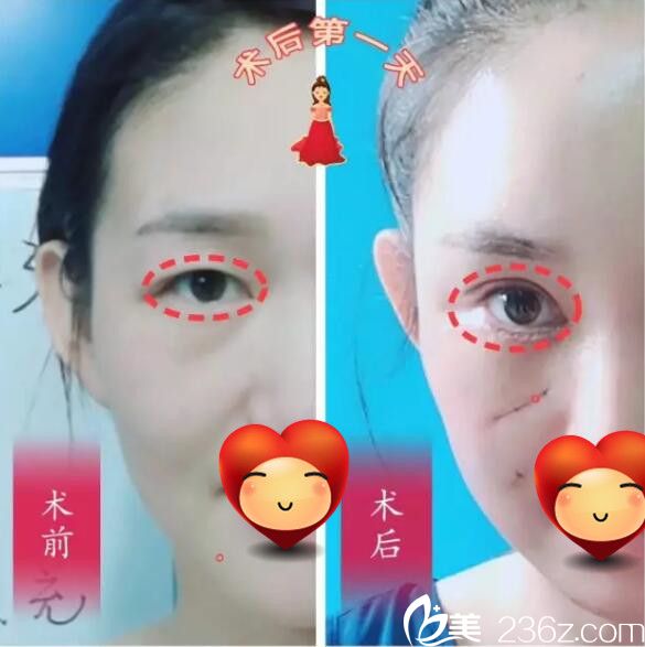 術(shù)后天整形恢復(fù) 術(shù)后天整形恢復(fù)