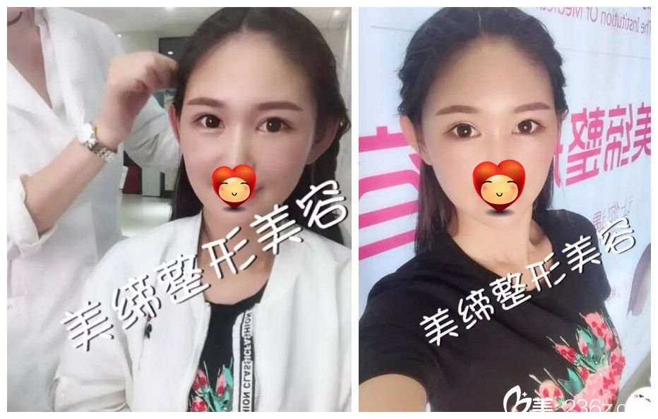 埋線成了內(nèi)雙找連云港美締周震明重新做眼綜合+全面部脂肪填充過(guò)程