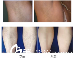 孟雪梅主任脫毛案例