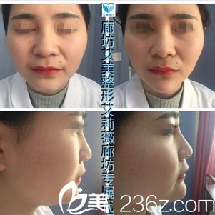 <!--<i data=20240703-sp></i>-->醫(yī)生注射玻尿酸案例